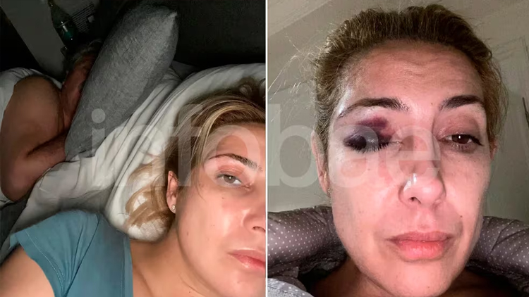 POLÍTICA: Se conocieron nuevas fotos de Fabiola Yañez con golpes en su cara